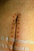 Bowel operation scar