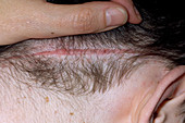 Scar from removal of a neurofibroma