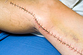 Heart surgery leg scar