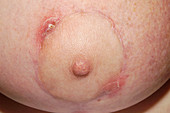 Infected scar after breast surgery