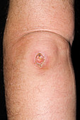 Post-operative wound scab