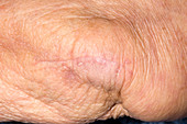Post-operative scar