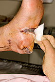 Dressing melanoma excision wound