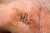 Melanoma biopsy scar