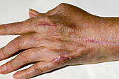 Surgical scars