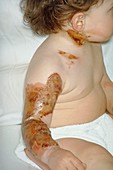 2nd degree burns to upper arm and neck of a child