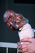 Burned hand in sterile plastic bag