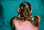 Severe burns to a man's neck & shoulders
