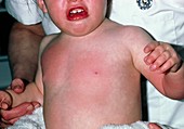 Hot water burns on an infant's chest