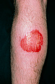 Infected leg burn from steam cleaner