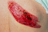 Burn on woman's shoulder from resting on radiator