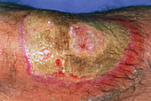 Close-up of a burn due to lime on the leg