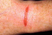 Close-up of burn on woman's arm from a saucepan