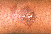 Blistering caused by a burn from a hot iron