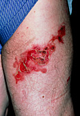 Boiling water burn on a 58 year old man's leg