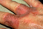 Burns treatment