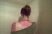 Sunburnt back