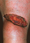Skin graft on leg