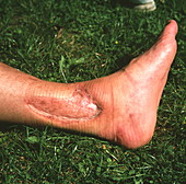 Ankle skin graft