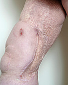 Skin graft scar