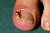 Close-up of skin surrounding ingrowing toenail