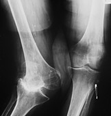 X-Ray showing congenital deformity of the knee