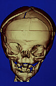 3-D CT scan of infant skull post-op for deformity