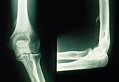 X-ray of Ligament of Struthers on the elbow joint
