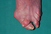Hallux valgus: bent and twisted toes due to bunion