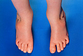 Child's feet with talipes (club foot) deformity