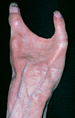 Congenital absence of three fingers