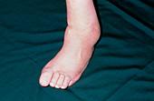 Deformed neuropathic foot