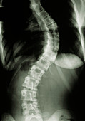 X-ray showing scoliosis (curvature) of the spine