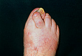 Hallux valgus on foot of 88 year-old woman