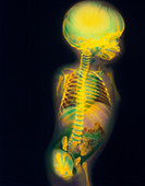 Coloured X-ray of thalidomide child with deformity
