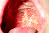 Repaired cleft palate in mouth of 18-year-old man