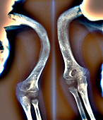 Deformed upper arm bones,X-rays