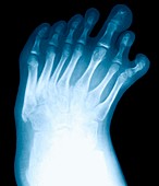 Seven-toed foot,X-ray