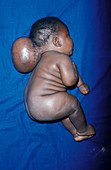 Birth deformity