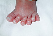 Polydactyly: a six-toed foot