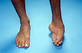 Uncorrected clubfoot