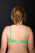 Postural scoliosis after treatment