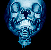 Cleft lip,3D CT scan