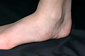 Deformity due to flat foot