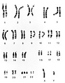 Karyotype of chromosomes in Down's syndrome