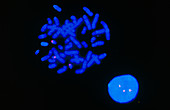 FISH micrograph of chromosomes in Down's Syndrome