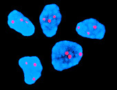 FISH micrograph of chromosomes in Down's Syndrome