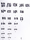 Chromosomes showing triploidy