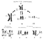 Burkitt's lymphoma