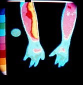 Thermogram of arms & hands after smoking